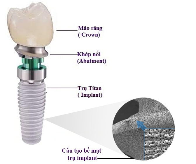 Cấu tạo của răng Implant