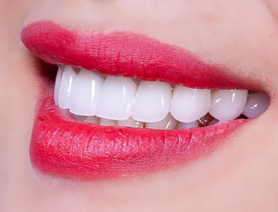 TOP 4 FORM RĂNG SỨ ĐƯỢC KHÁCH HÀNG ƯA CHUỘNG NHẤT HIỆN NAY GIÚP NỤ CƯỜI TỎA SÁNG