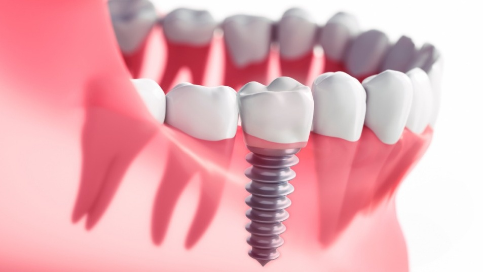 Cấy ghép Implant không rạch lợi tỷ lệ thành công cao hơn so với phương pháp Implant truyền thông