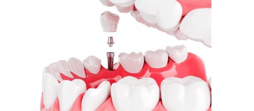 Phục hình sứ tức thì trên Implant đạt hiệu quả cao hơn so với phương pháp truyền thống