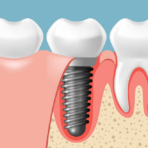 Cấy ghép Implant không rạch lợi giảm đau đớn hơn so với phương pháp thông thường