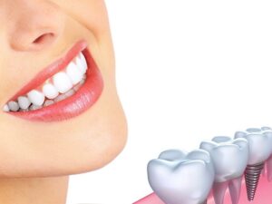 HƯỚNG DẪN CÁCH CHĂM SÓC ĐÚNG CÁCH SAU KHI TRỒNG IMPLANT