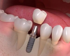 IMPLANT KHÔNG RẠCH LỢI: BƯỚC TIẾN MỚI TRONG NHA KHOA, HIỆU QUẢ CAO, AN TOÀN CHO KHÁCH HÀNG