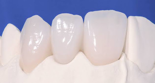 SỨ EMAX - DÒNG SỨ CAO CẤP CHO NỤ CƯỜI HOÀN MỸ 2 su emax dong su cao cap cho nu cuoi hoan my 2