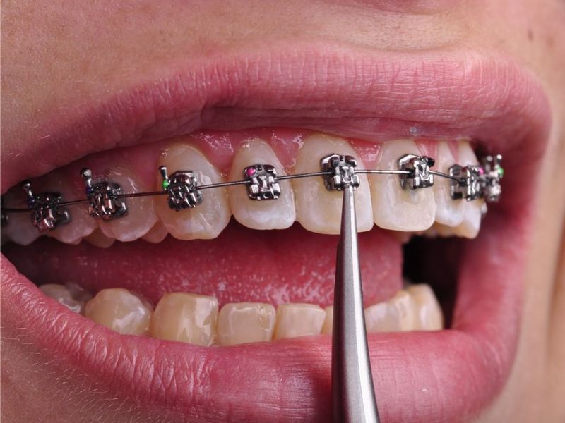 BỊ VIÊM NHA CHU CÓ NIỀNG RĂNG ĐƯỢC KHÔNG? 3 bi viem nha chu co nieng rang duoc khong 3