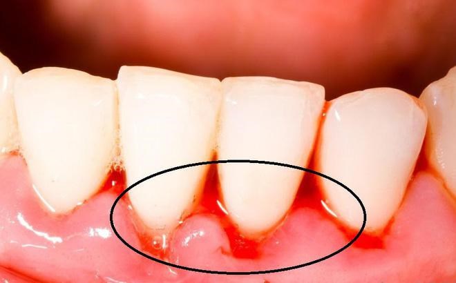 Cách Khắc Phục Tình Trạng Bọc Răng Sứ Bị Chảy Máu 2 cach khac phuc tinh trang boc rang su bi chay mau 2