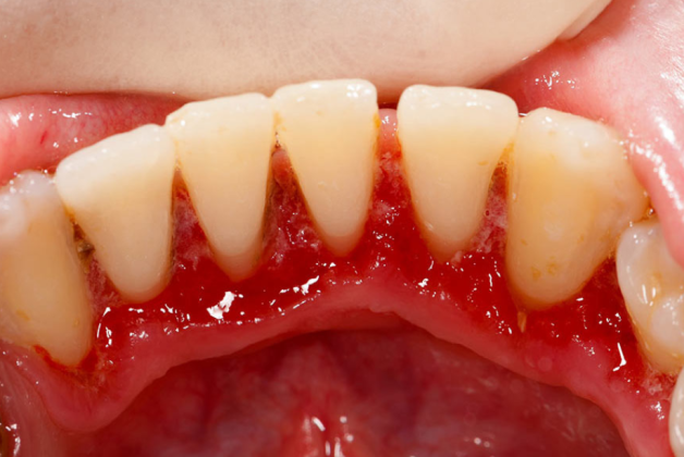 Cách Khắc Phục Tình Trạng Bọc Răng Sứ Bị Chảy Máu 3 cach khac phuc tinh trang boc rang su bi chay mau 3