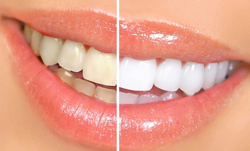 TẨY TRẮNG RĂNG CÓ ĐAU KHÔNG? ĐỊA CHỈ TẨY TRẮNG RĂNG HIỆU QUẢ TẠI TP.HCM 1 Răng trước và sau khi tẩy trắng