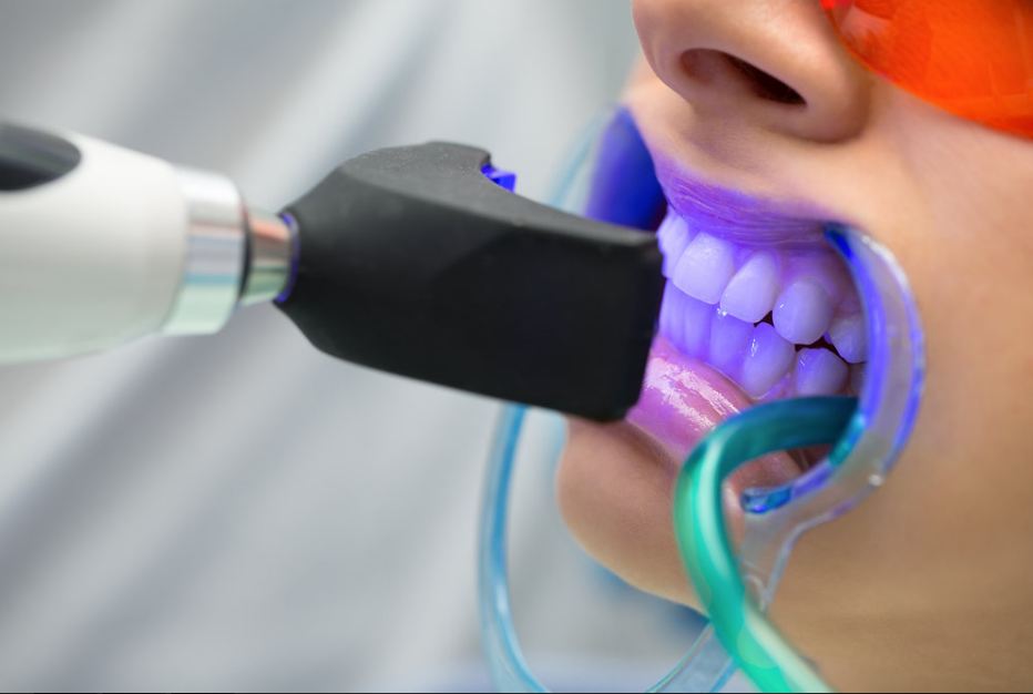 TẨY TRẮNG RĂNG CÓ ĐAU KHÔNG? ĐỊA CHỈ TẨY TRẮNG RĂNG HIỆU QUẢ TẠI TP.HCM 2 Công nghệ chiếu đèn led khi thực hiện tẩy trắng răng