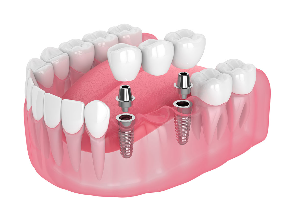 Quy trình trồng răng Implant chuẩn y khoa tại Dr.SmileCare Quy trình trồng răng Implant chuẩn y khoa tại Dr.SmileCare