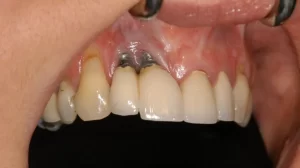 Viêm nướu quanh Implant có nguy hiểm không?