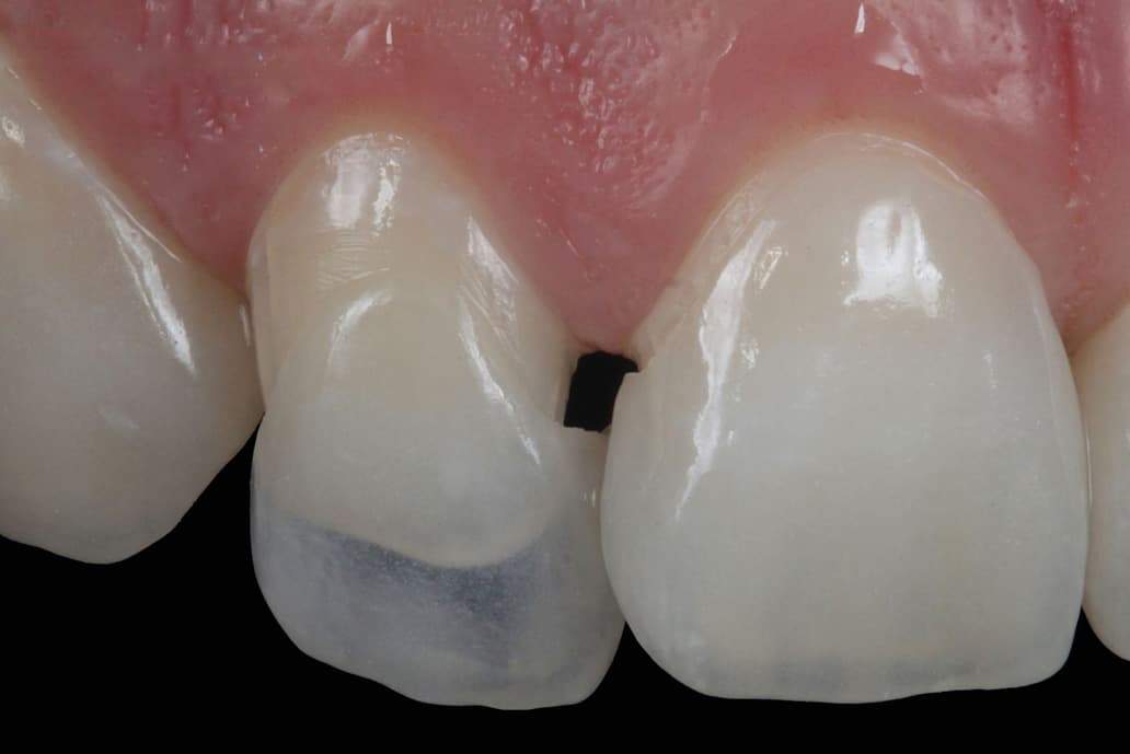 Dán sứ Veneer