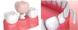 Vì sao nhiều người chọn sai giữa bọc sứ và dán sứ Veneer