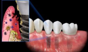 Vì sao "giá rẻ" trong nha khoa tiềm ẩn nhiều rủi ro hơn bạn nghĩ