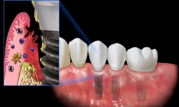 Vì sao "giá rẻ" trong nha khoa tiềm ẩn nhiều rủi ro hơn bạn nghĩ