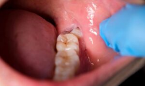 Quy trình nhổ răng khôn an toàn tại Dr.SmileCare