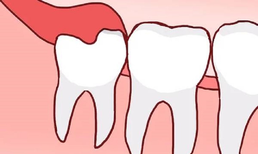 Không phải răng khôn nào cũng cần nhổ bỏ Không phải răng khôn nào cũng cần nhổ bỏ