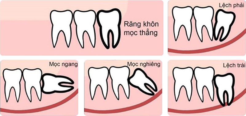 Vì sao răng khôn thường gây biến chứng và khi nào cần nhổ?