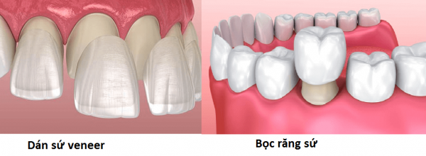 So sánh bọc răng sứ và dán sứ Veneer