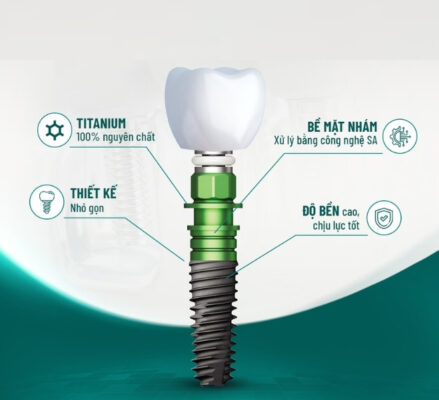 Đặc điểm công nghệ của trụ Implant Hiossen