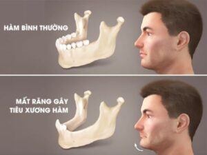 Tiêu xương hàm sau mất răng diễn ra như thế nào theo thời gian?