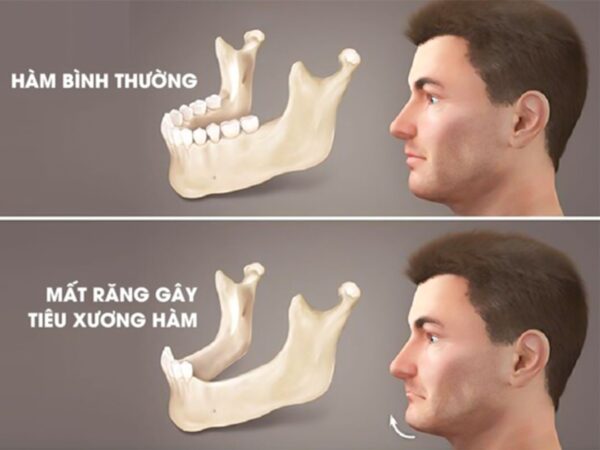 Tiêu xương hàm sau mất răng diễn ra như thế nào theo thời gian?