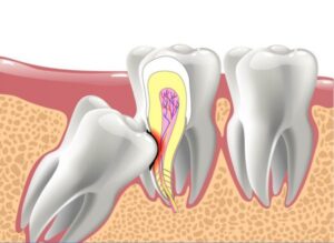Quy trình đánh giá và xử lý răng khôn tại Dr.SmileCare