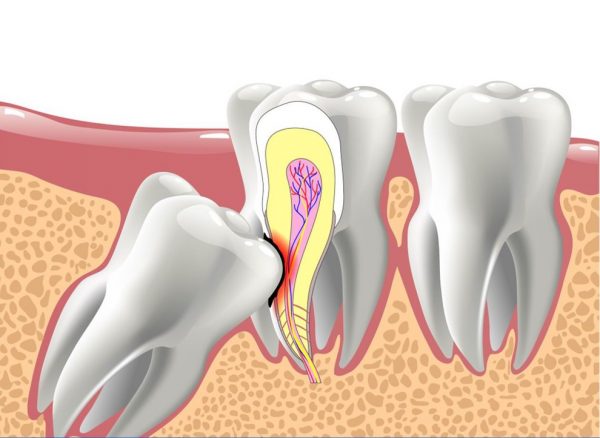 Quy trình đánh giá và xử lý răng khôn tại Dr.SmileCare