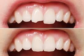 Vì sao răng sứ bị mẻ khiến nhiều người lo lắng?