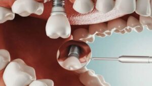 Nguy cơ nếu chăm sóc sai cách sau khi trồng Implant và làm răng sứ