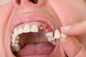 Răng chỉ còn chân để lâu không xử lý có sao không?