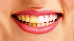 Vì sao răng ố vàng? Hai nhóm nguyên nhân cần phân biệt