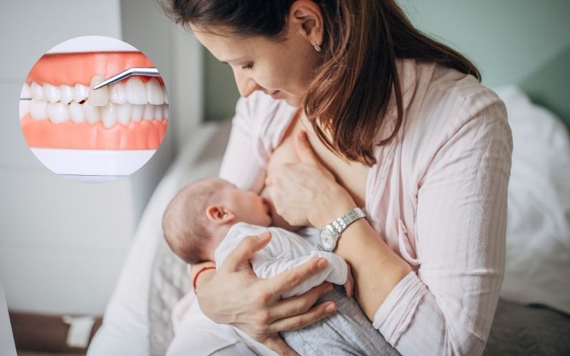 Mẹ cho con bú có làm răng sứ, trồng Implant được không?