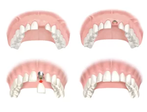 Vì sao Implant răng cửa khó hơn răng hàm?