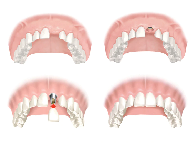 Vì sao Implant răng cửa khó hơn răng hàm?