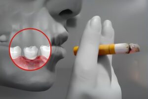 Người hút thuốc lá có trồng Implant được không?