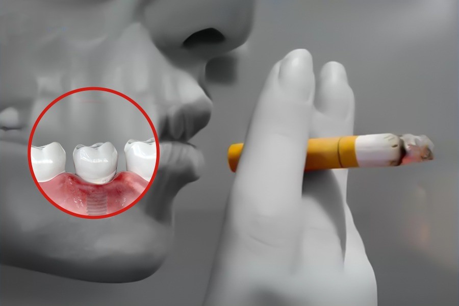 Người hút thuốc lá có trồng Implant được không?